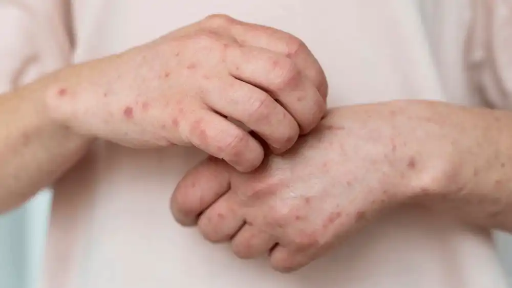 Syphilis_02 » The Mainstream โรคติดต่อทางเพศสัมพันธ์, HIV, ซิฟิลิส, วัยรุ่นไทย, ถุงยางอนามัย